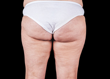 Emtone PIC 003 After buttock female Melissa French 4TX 825x592