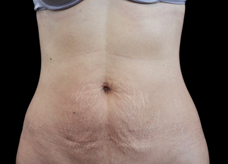 Emtone PIC 002 After abdomen female Klaus Fritz MD 4TX 825x592