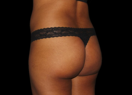 BTL Emsculpt PIC 036 before female Cris Bailey MD 2 ems