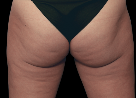 Help! Cellulite Is Overtaking My Body!