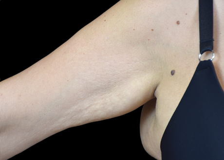 Emtone PIC 005 After arm female BTL Aesthetics 4TX 825x592