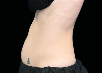 Core to Floor 002 Before Female Abdomen JD Mccoy MD