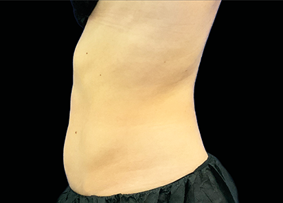 Core to Floor 004 after Female Abdomen JD Mccoy MD