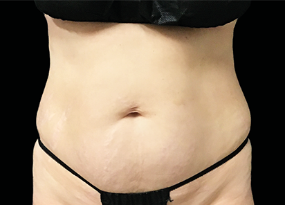 Core to Floor 007 After Female Abdomen Julene Samuels MD