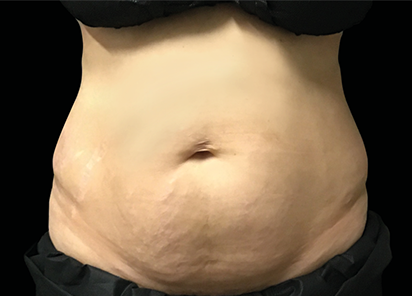Core to Floor 007 Before Female Abdomen Julene Samuels MD