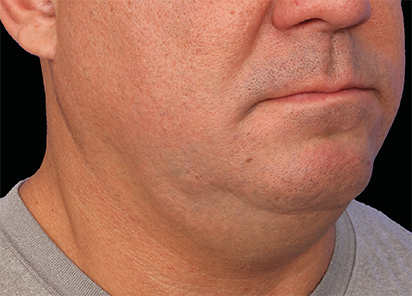 Emface PIC115 Before submentum male Barry DiBernardo MD 4TX 412x296px