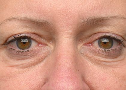 Emface PIC Ba card female eyes 160 ENUS100 before