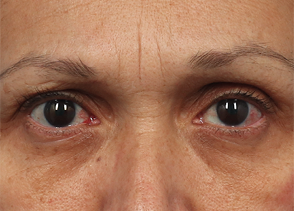 Emface PIC Ba card female eyes 172 ENUS100 before