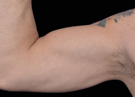 Emsculpt Arms After Barry Dibernardo 95