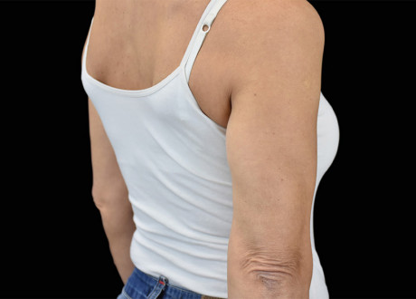 Emsculpt Arms After Bruce E Katz 86