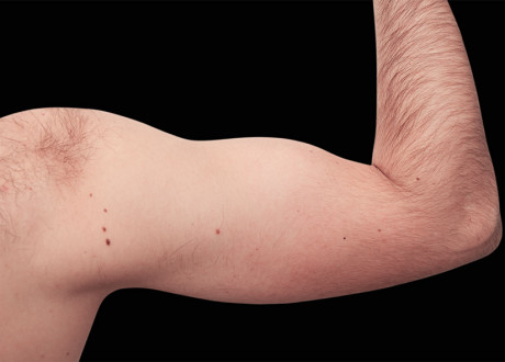 Emsculpt Arms After Raminder Saluja 79