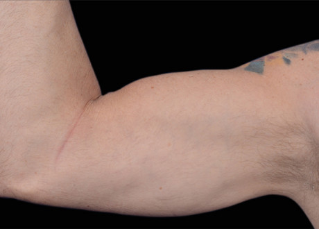 Emsculpt Arms Before Barry Dibernardo 95