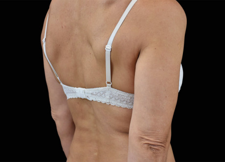 Emsculpt Arms Before Bruce E Katz 86