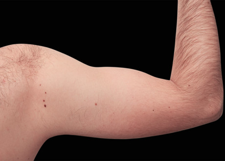 Emsculpt Arms Before Raminder Saluja 79