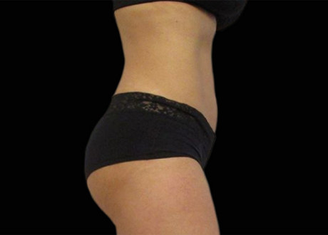 Emsculpt Buttocks After Michael A Persky 93