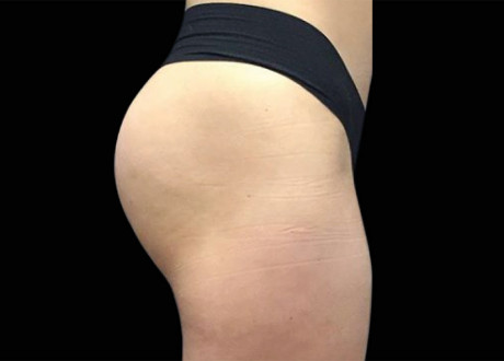 Emsculpt Buttocks After Seaside Aesthetics 94