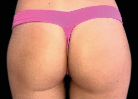 Emsculpt Buttocks After Siamak Agha 58