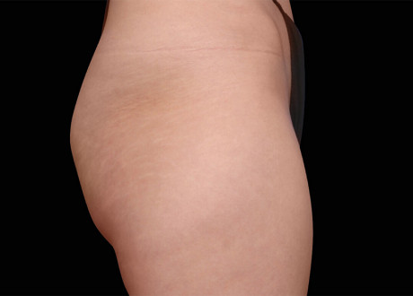 Emsculpt Buttocks Before Lasky Aesthetics 49