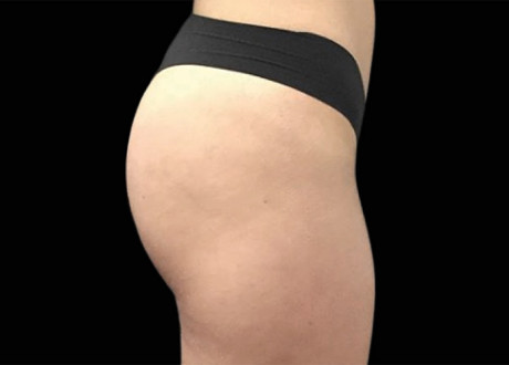 Emsculpt Buttocks Before Seaside Aesthetics 94