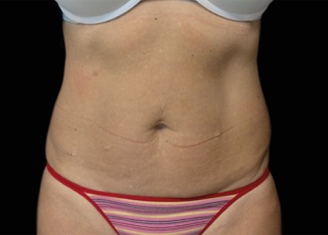 Emsculpt Female Abdomen After David E Kent 034