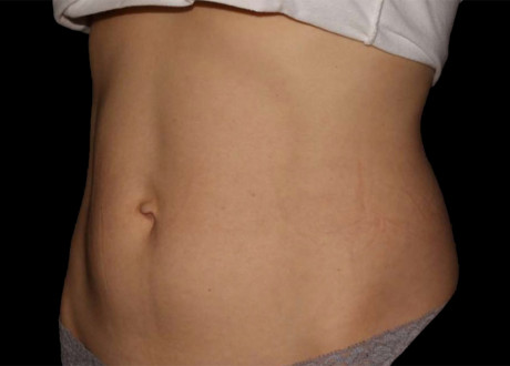 Emsculpt Female Abdomen After Project Skin 069