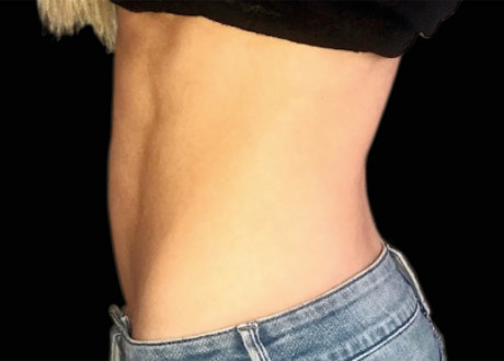 Emsculpt Female Abdomen After Siamak Agha 096