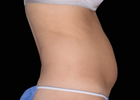 Emsculpt Female Abdomen Before Bruce Katz 003