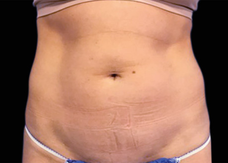 Emsculpt Female Abdomen Before Kevin Deuber 091