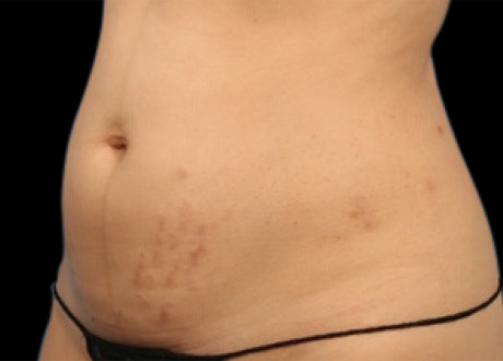 Emsculpt Female Abdomen Before Melanie Palm 068