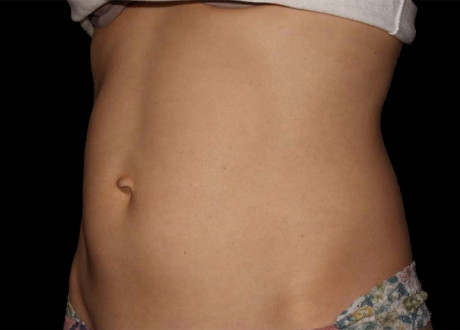 Emsculpt Female Abdomen Before Project Skin 069