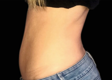 Emsculpt Female Abdomen Before Siamak Agha 096