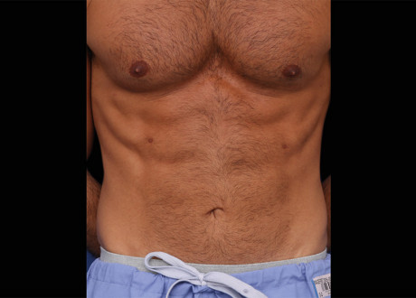 Emsculpt Male Abdomen After Lasky Aesthetics 061
