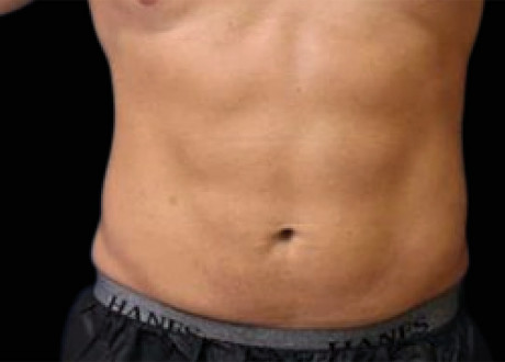 Emsculpt Male Abdomen After Richard Goldfarb 070