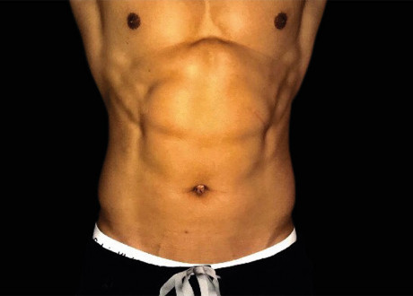 Emsculpt Male Abdomen After Siamak Agha 059