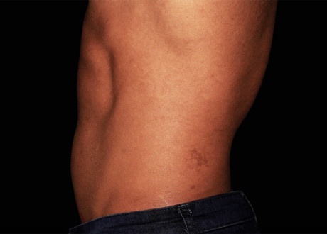 Emsculpt Male Abdomen After Suneel Chilukuri 055