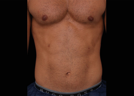 Emsculpt Male Abdomen Before Lasky Aesthetics 061