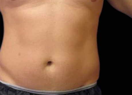 Emsculpt Male Abdomen Before Richard Goldfarb 070