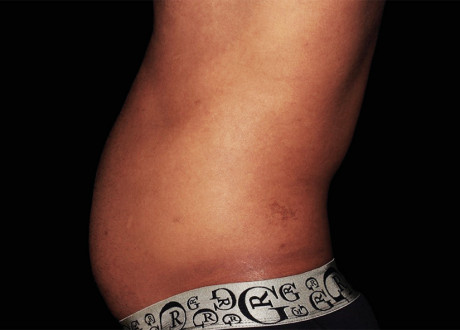 Emsculpt Male Abdomen Before Suneel Chilukuri 055