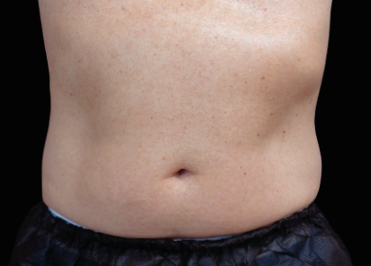 Emsculpt Neo - Less Fat More Muscle