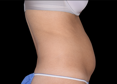 1 Before Emsculpt PIC 003 Before female Bruce Katz MD 4TX4W 412x296px