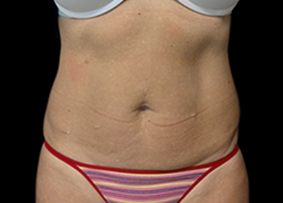 2 After Emsculpt PIC 034 After abdomen female David E Kent MD 8TX  412x296px