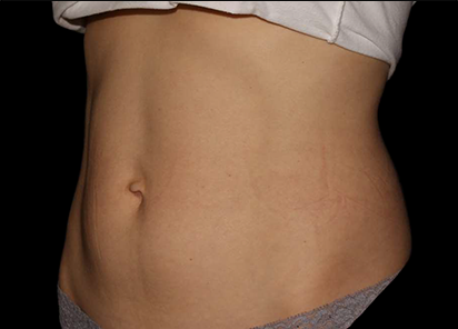4 After Emsculpt PIC 047 After abdomen female Project Skin MD 4TX 412x296