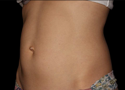 4 Before Emsculpt PIC 047 Before abdomen female Project Skin MD 412x296