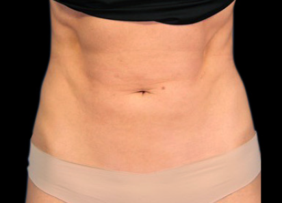 5 After Emsculpt PIC 091 After abdomen female Mark Deuber MD 12W 4TX 412x296px
