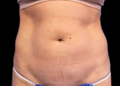 5 Before Emsculpt PIC 091 Before abdomen female Mark Deuber MD 412x296px