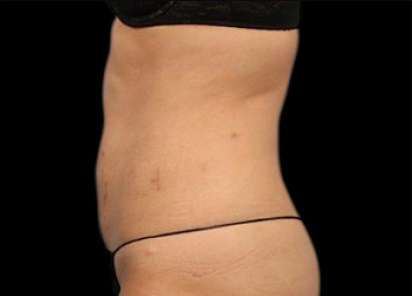 6 After Emsculpt PIC 062 After abdomen female Melanie Palm MD 4W 4TX 412x296