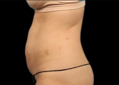 6 Before Emsculpt PIC 062 Before abdomen female Melanie Palm MD 412x296
