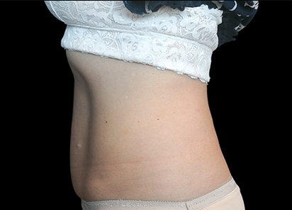 7 After BTL Emsculpt PIC 002 After female David E Kent MD 8TX 412x296px