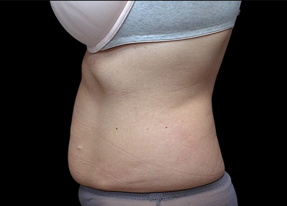 7 Before BTL Emsculpt PIC 002 Before female David E Kent MD 8TX 412x296px