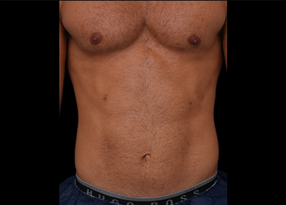 1 Before Emsculpt PIC 061 Before abdomen male Lasky Aesthetics 412x296px